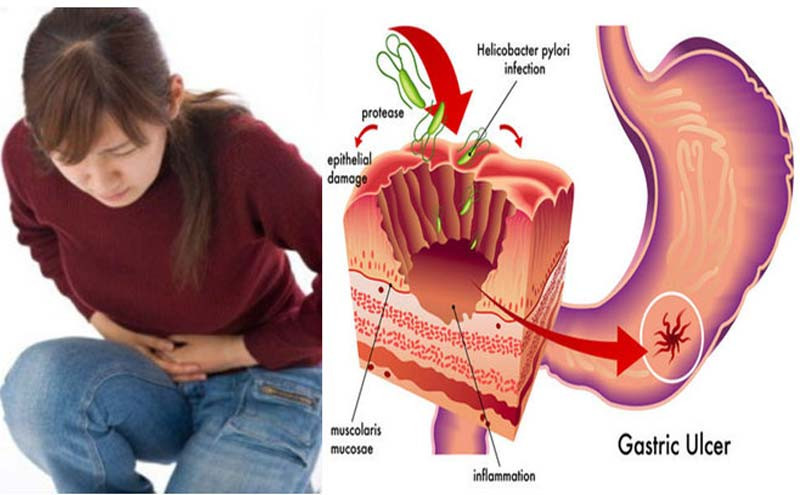 ग्यास्ट्रिकले सताएकाे छ ? यस्ता घरेलु उपचार गरे निकाे हुन्छ