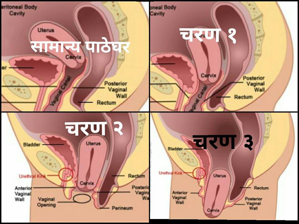 डोल्पामा पहिलोपटक आङ खस्ने महिलाको पहिचान