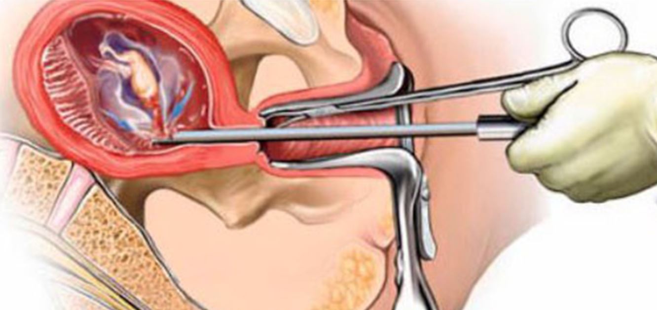 किन बढ्दै छ असुरक्षित गर्भपतन गराउनेको सङ्ख्या ?